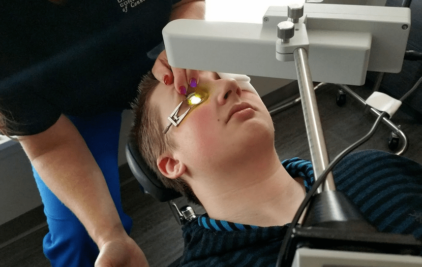 A reticulação elimina efetivamente o queratoconus no início de seu desenvolvimento