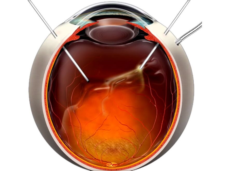 Vitrectomia - um procedimento mostrado às pessoas quando a esfoliação da retina